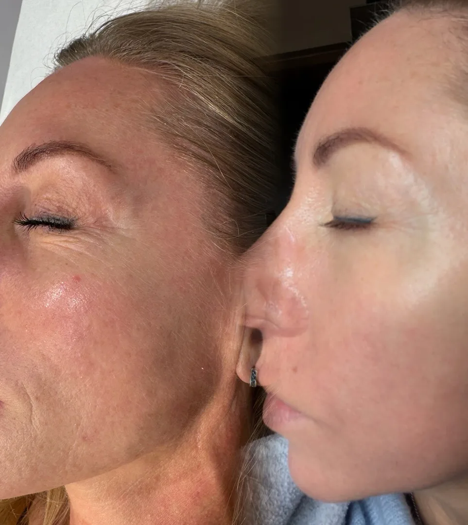 Efekty-2 Efekty przed i po zabiegu przy użyciu lasera tulowego