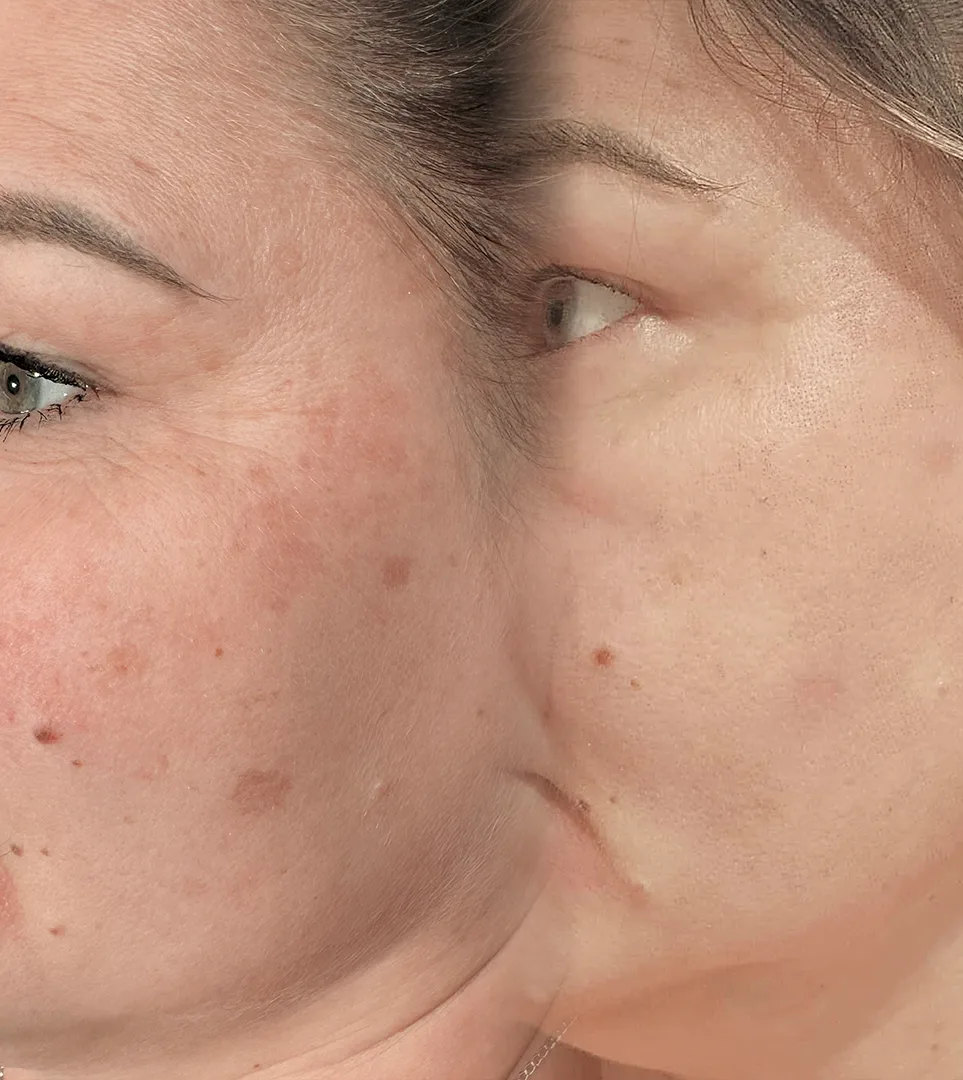 Efekty-3 Efekty przed i po zabiegu przy użyciu lasera tulowego