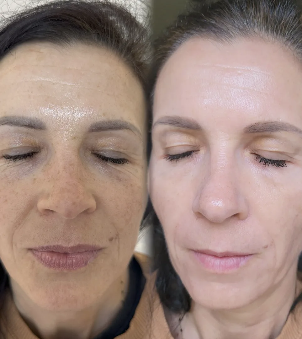 Efekty-4 Efekty przed i po zabiegu przy użyciu lasera tulowego