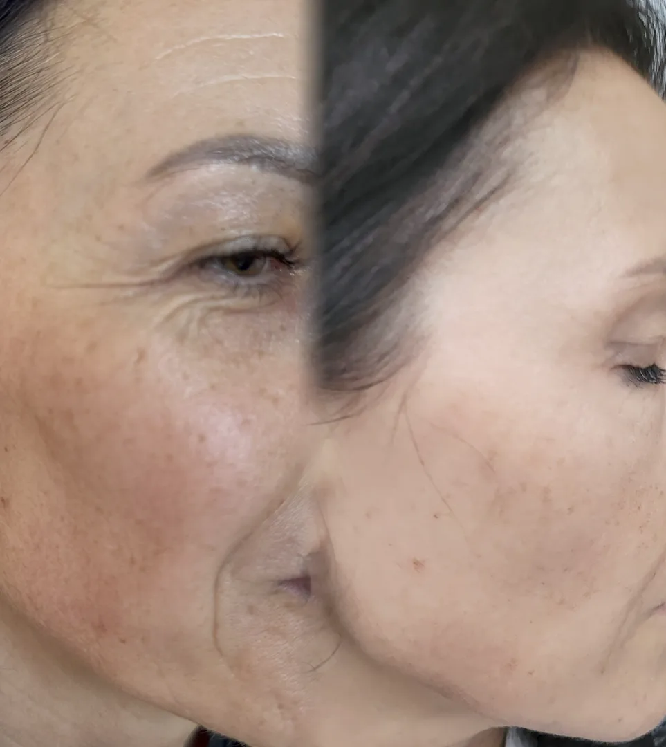 Efekty-5 Efekty przed i po zabiegu przy użyciu lasera tulowego