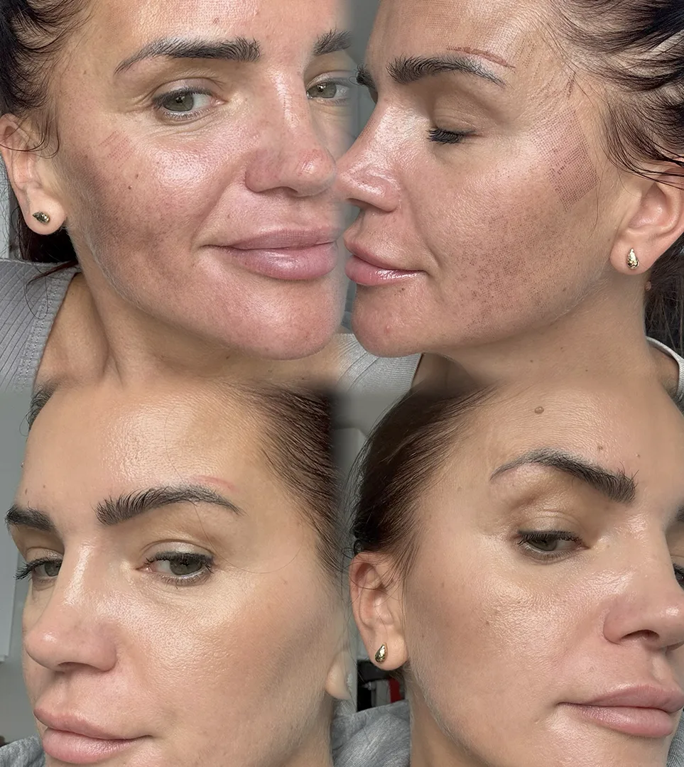 Efekty-6 Efekty przed i po zabiegu przy użyciu lasera tulowego