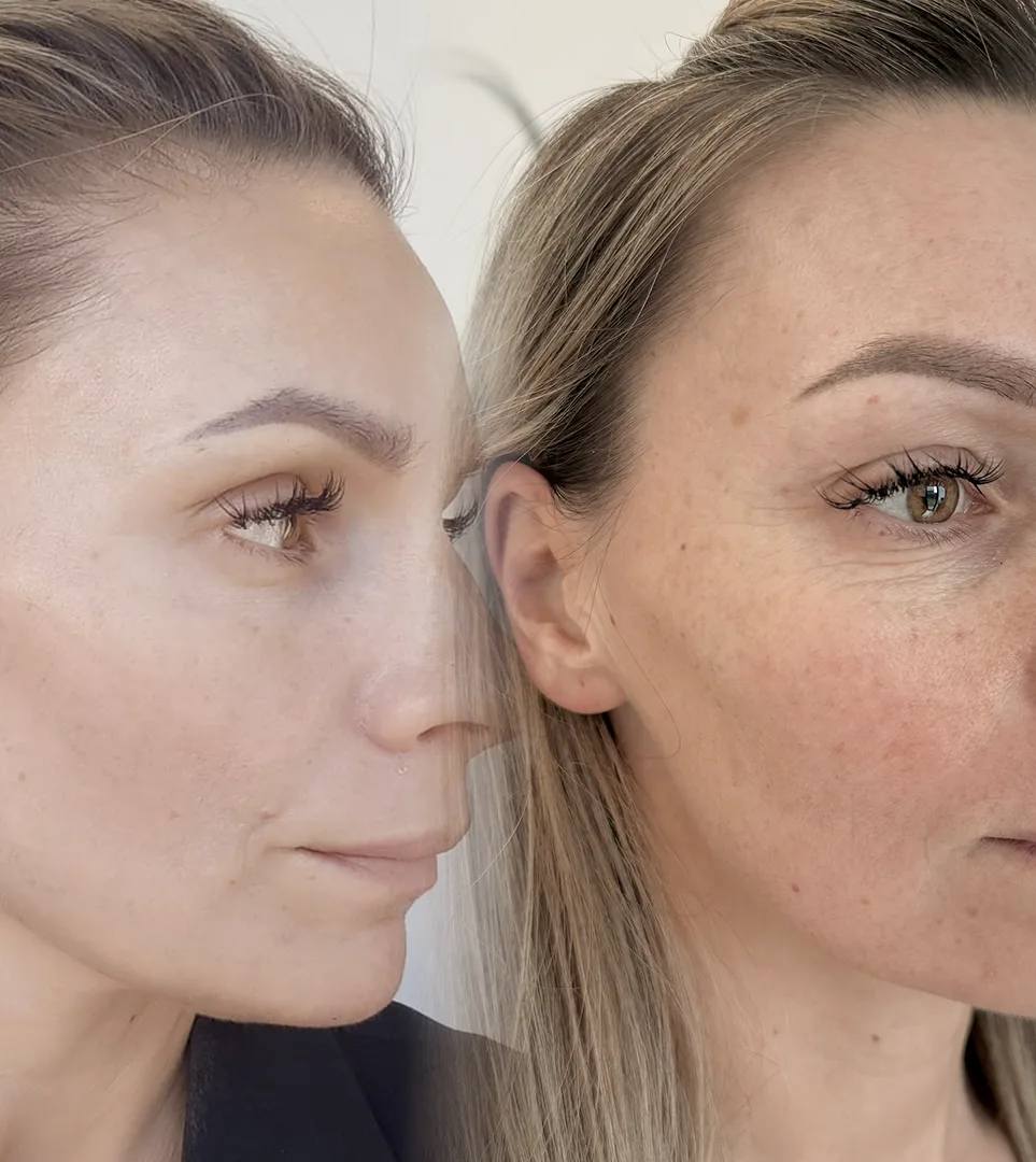 Efekty-7 Efekty przed i po zabiegu przy użyciu lasera tulowego