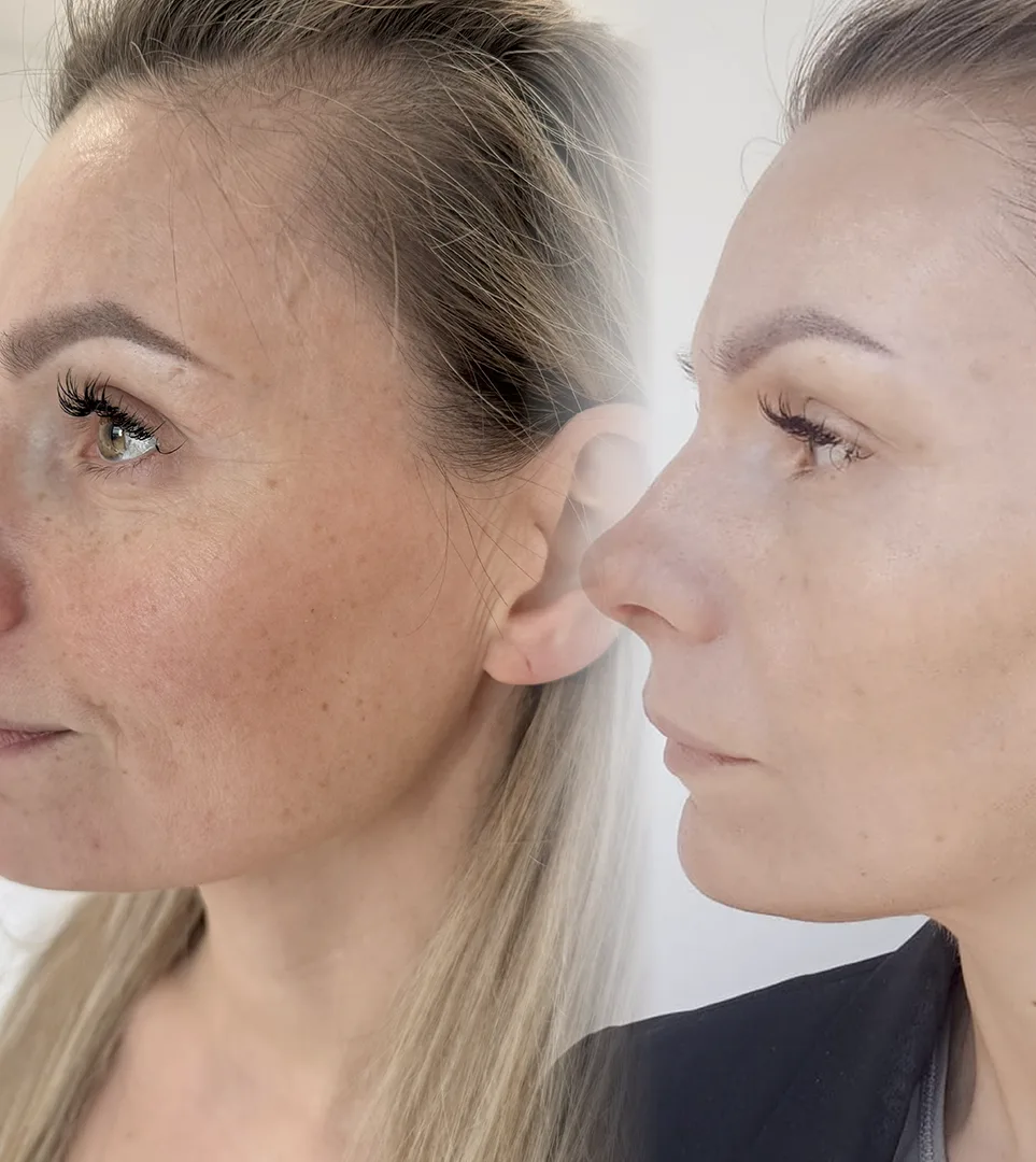 Efekty-8 Efekty przed i po zabiegu przy użyciu lasera tulowego