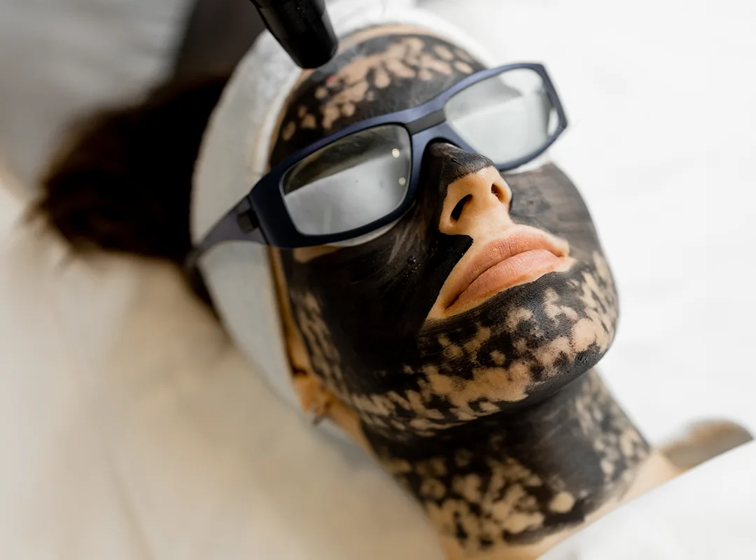 Peeling węglowy